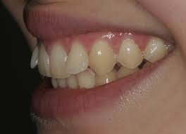 Sherman Oaks Teeth Malocclusion treatment patient model