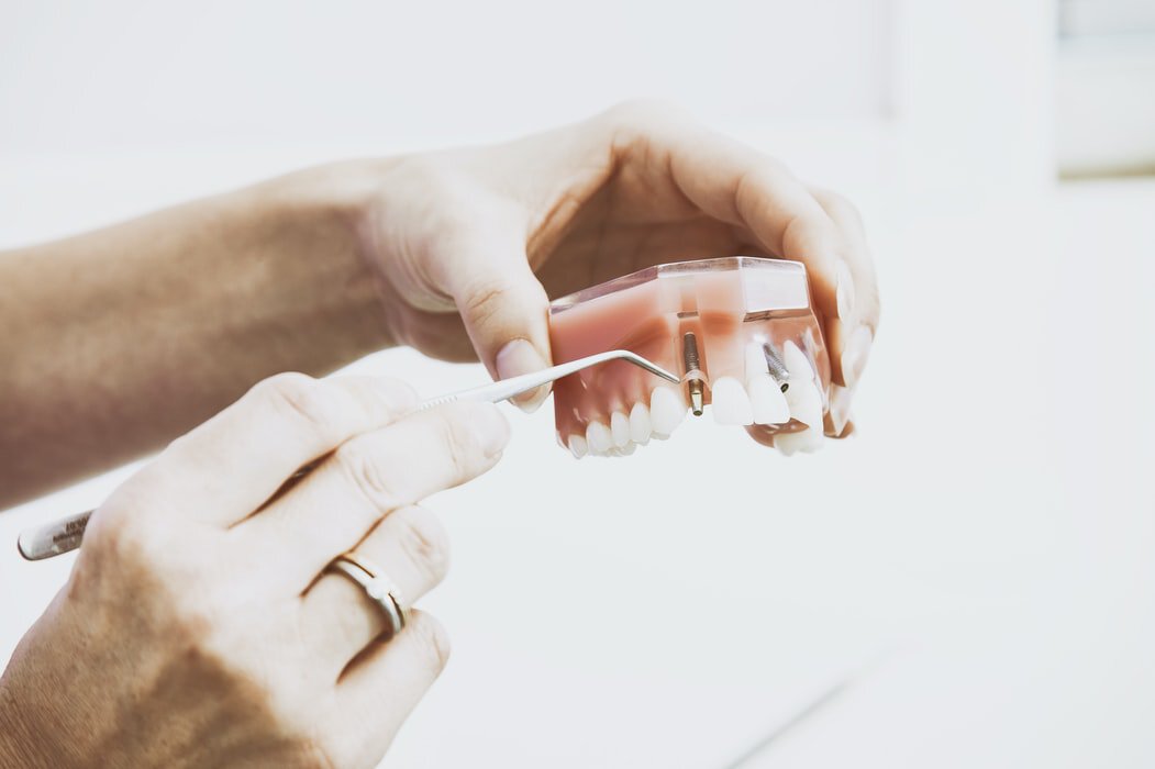 Sherman Oaks implant dentist showing all on 4 model