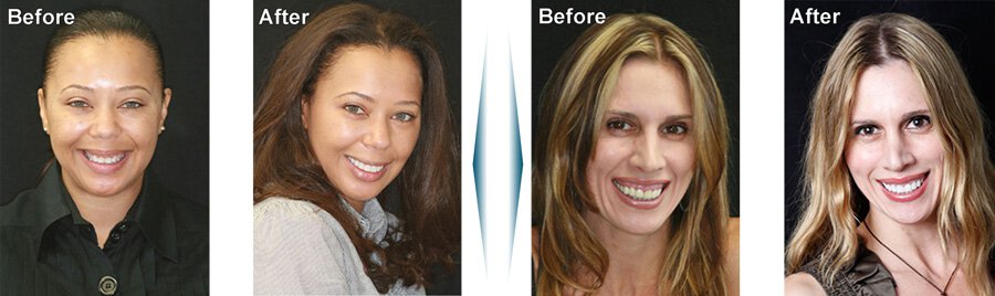 Sherman Oaks smile correction patient models before and after