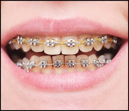 Sherman Oaks TMJ treatment patient model with braces