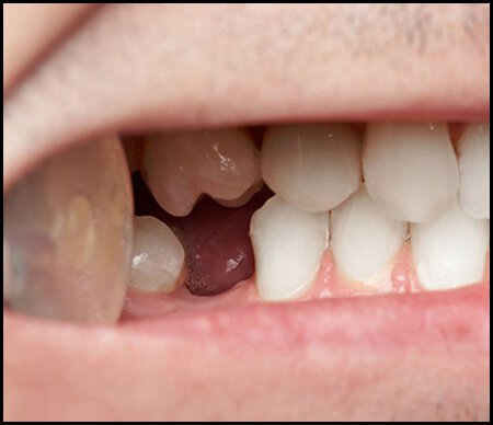 Sherman Oaks TMJ treatment patient model with missing tooth