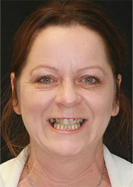 Sherman Oaks Cosmetic Dentistry Patient 26 - Before