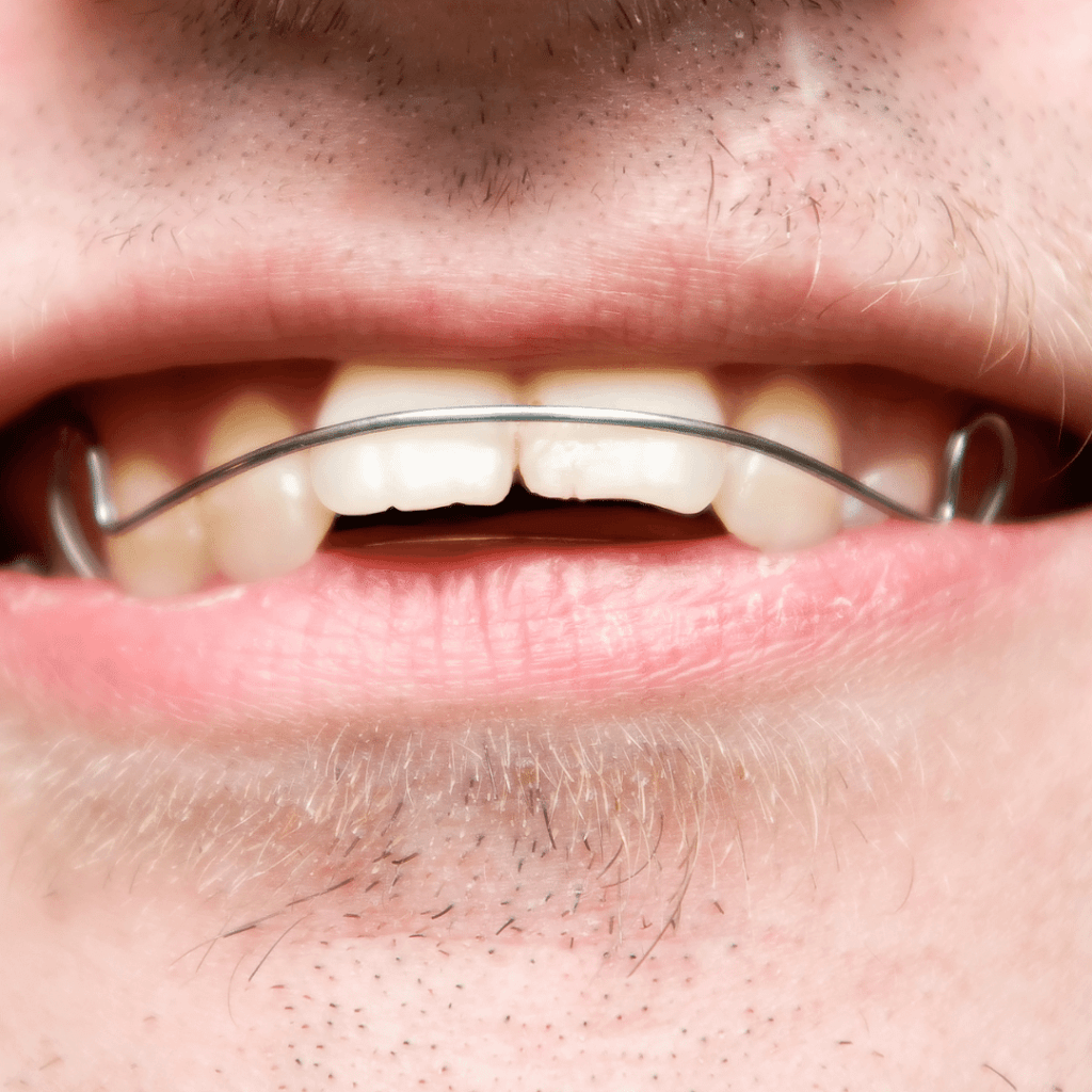 Underbite vs. Overbite: What's the Difference and How are They