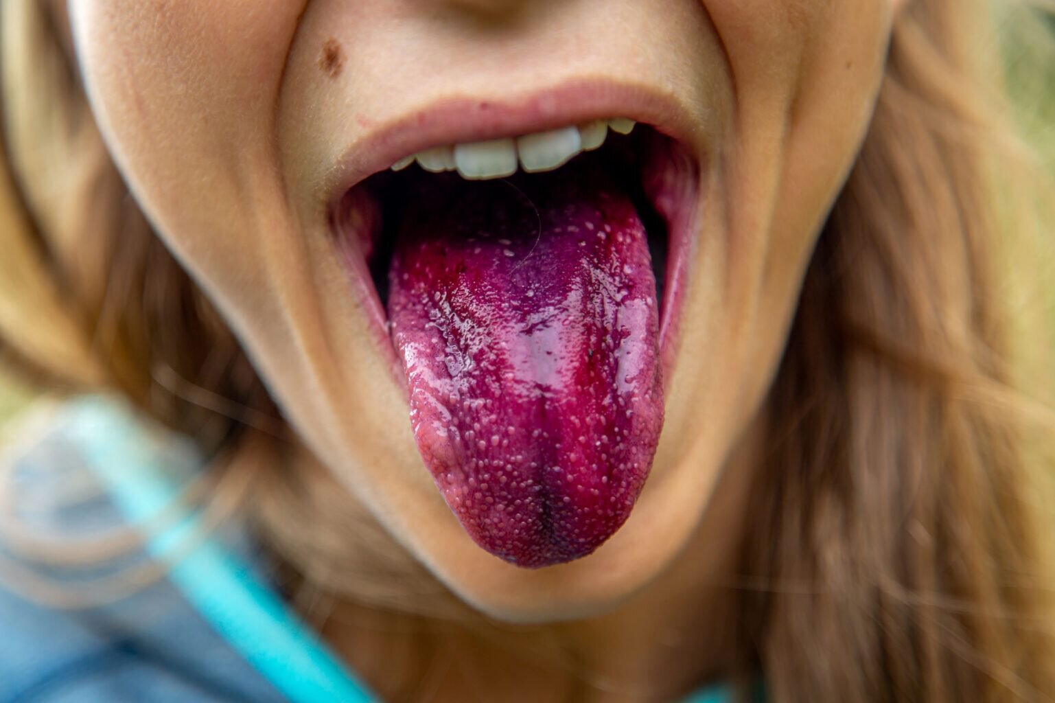 dental patient model with a purple tongue