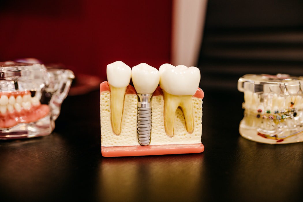 Titanium screws for dental implants in a model