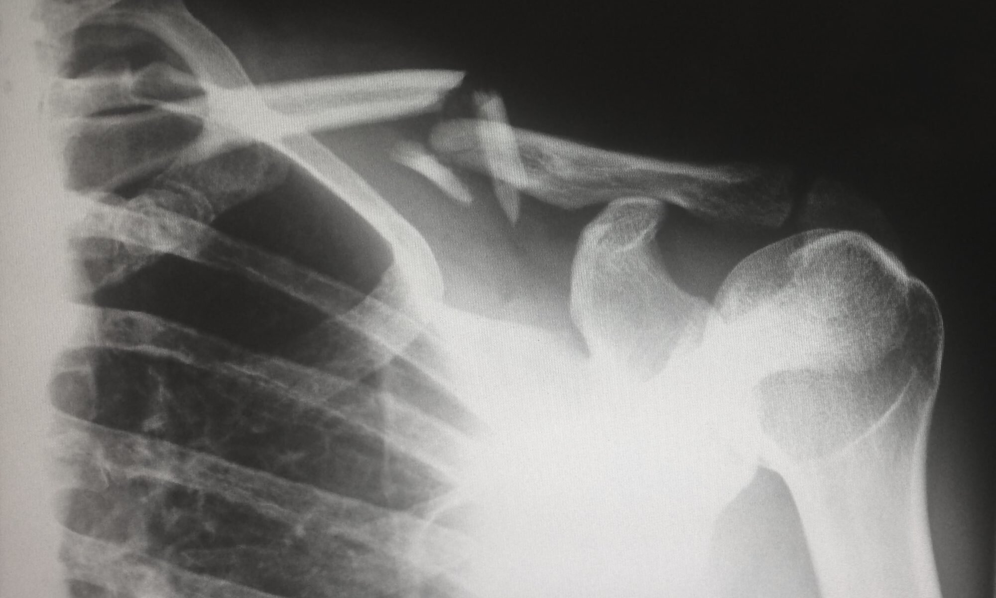 xray image showing a broken clavicle