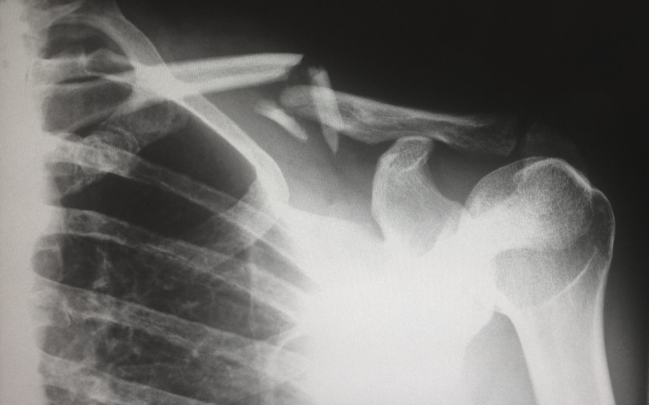 x ray showing a broken clavicle