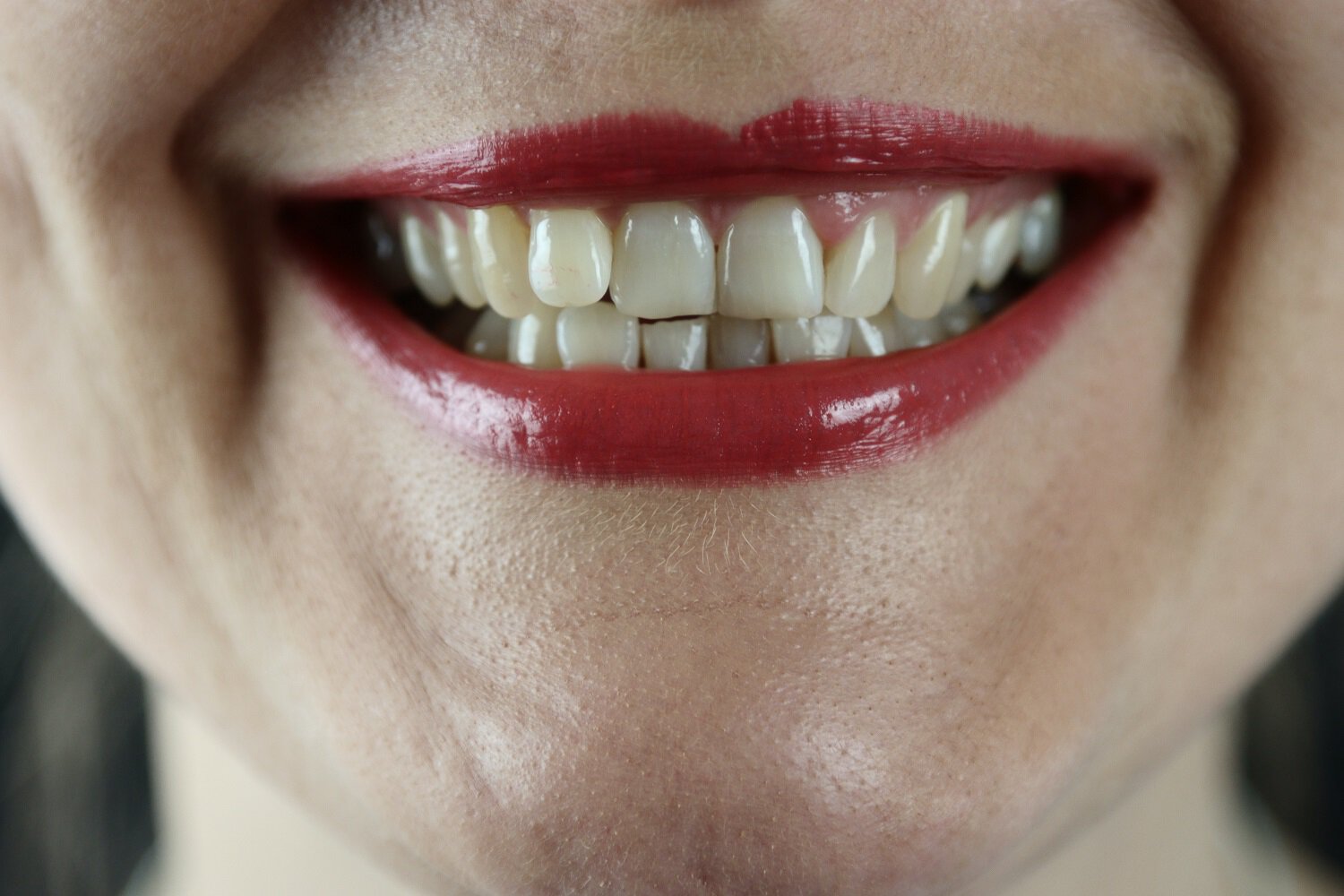 Sherman Oaks bruxism patient model with crooked teeth with red lipstick