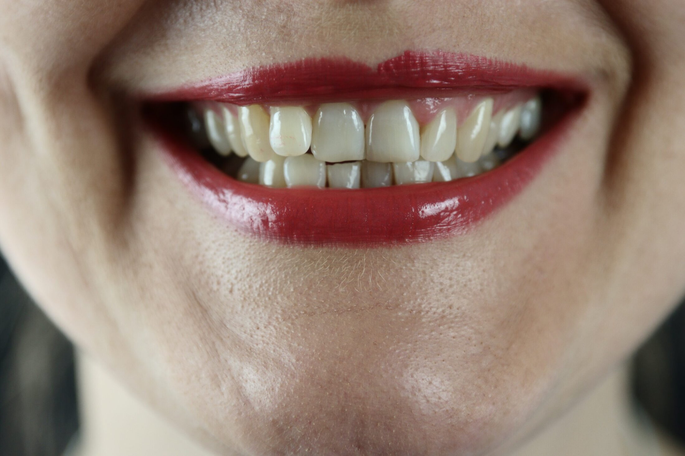 cosmetic dentistry patient model with crooked teeth and red lipstick