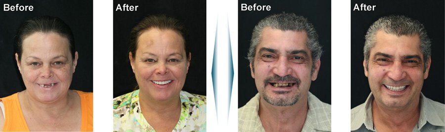Sherman Oaks Denture patients before and after
