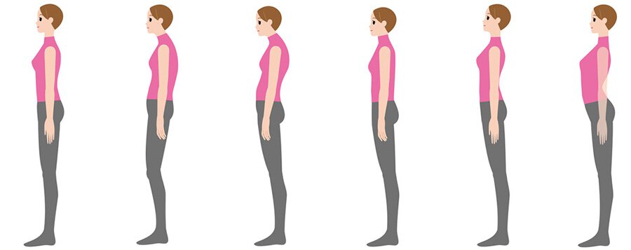 Sherman Oaks TMJ treatment animated models displaying posture