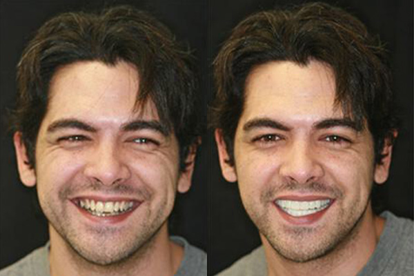 sherman oaks smile rejuvenation patient before and after