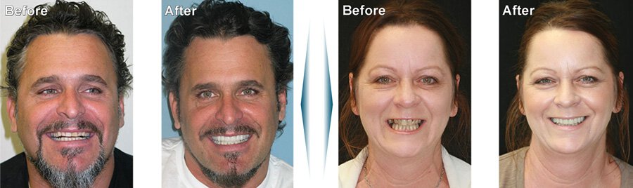 Sherman Oaks Dental Implants patients before and after