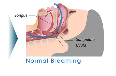 Sherman Oaks snoring treatment infographic of normal breathing