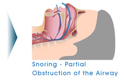 Sherman Oaks snoring treatment infographic of obstructive breathing