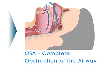 Sherman Oaks snoring treatment infographic of complete obstructive breathing
