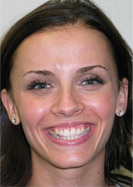 Sherman Oaks Cosmetic Dentistry Patient 04 - Before