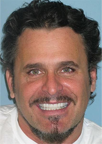 Sherman Oaks Cosmetic Dentistry Patient 21 - After