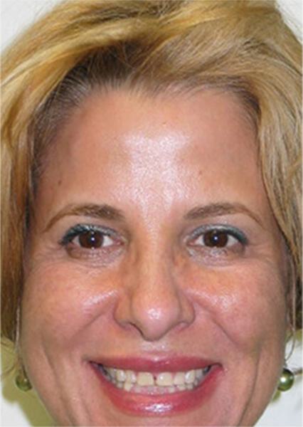 Sherman Oaks Cosmetic Dentistry Patient 23 - Before