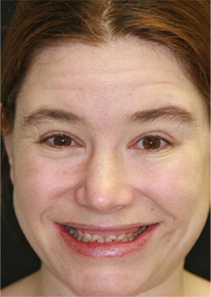 Sherman Oaks Cosmetic Dentistry Patient 29 - Before