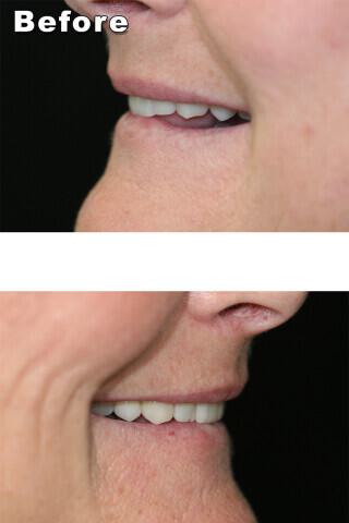 TMJ Treatments Gallery Before & After Image