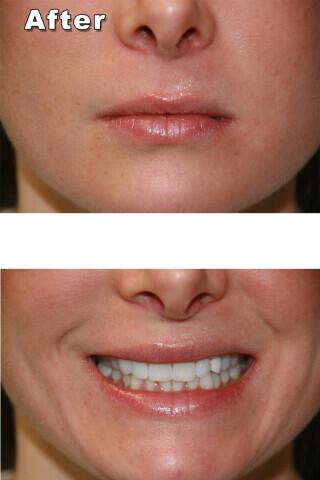 TMJ Treatments Gallery Before & After Image